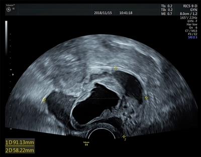 Uterine cervical Müllerian adenosarcoma possibly arising from ovarian cystadenofibroma: A case report and review of the literature